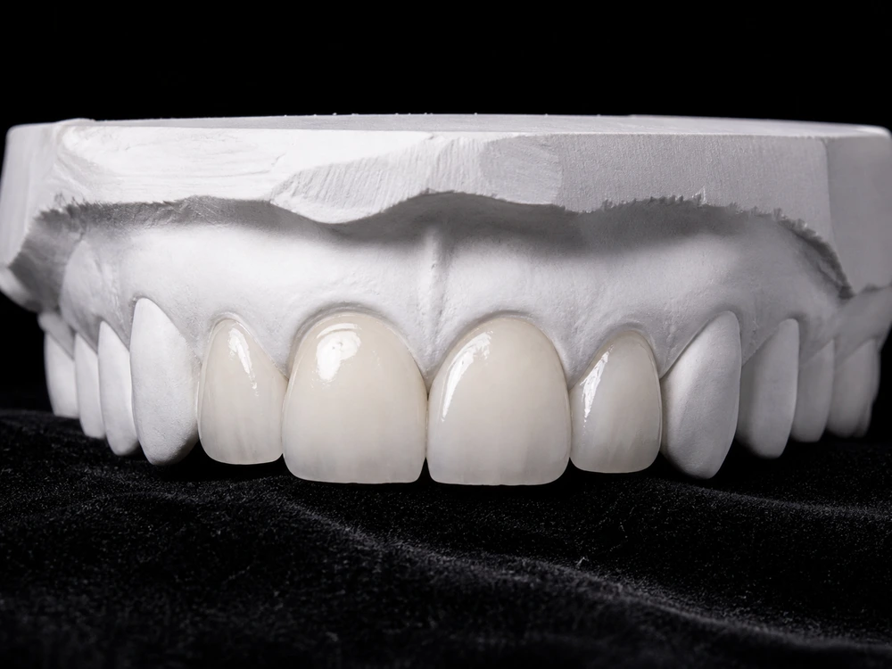 Celebrity teeth before and after veneers dramatic transformation comparison