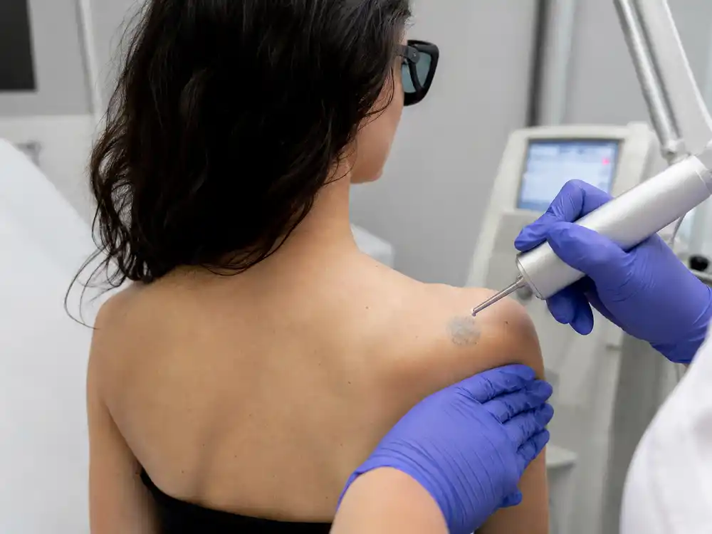 Rose McGowan tattoos and their meanings removal — laser clinic session fading shoulder ink to blue spot since 2004